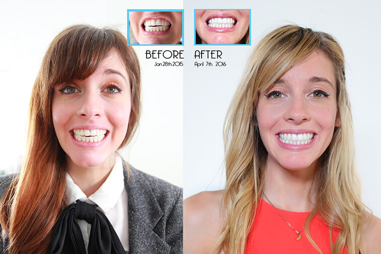 before and after Invisalign