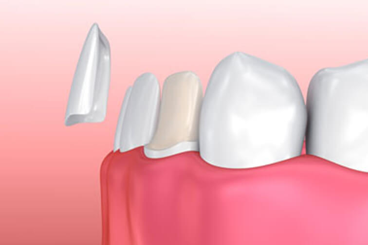 illustration of veneers