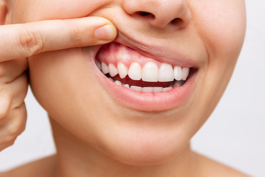 Closeup of a woman pulling up her upper lip to show her healthy gums in jonesboro