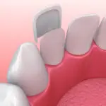 Closeup of a veneer being bonded to the front of a tooth in jonesboro