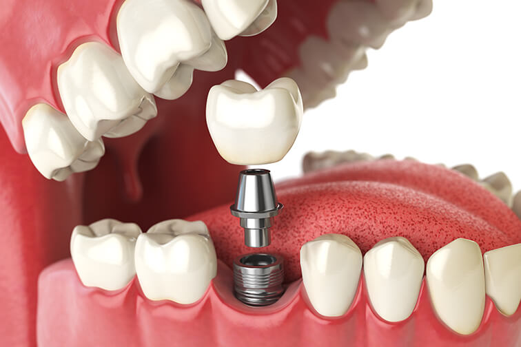 illustration of a dental implant