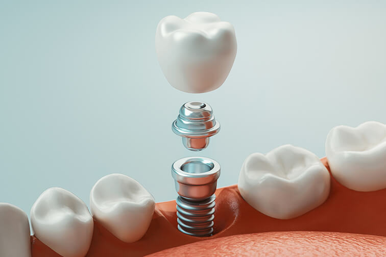 illustration of a dental implant