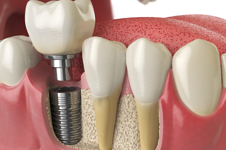 illustration of a dental implant