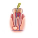 medically accurate graphic illustration of root canal, root canal recovery in jonesboro
