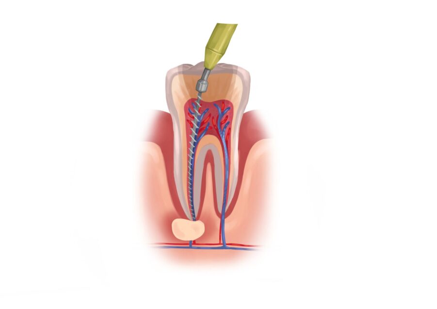 medically accurate graphic illustration of root canal, root canal recovery in jonesboro