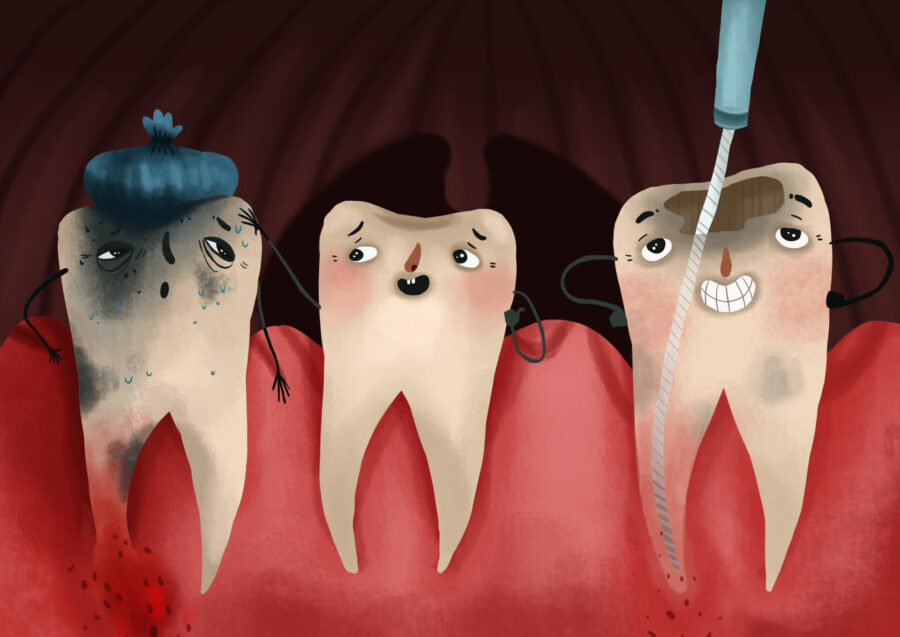 root canal therapy