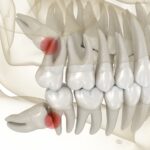 wisdom teeth removal, wisdom teeth pain and impaction