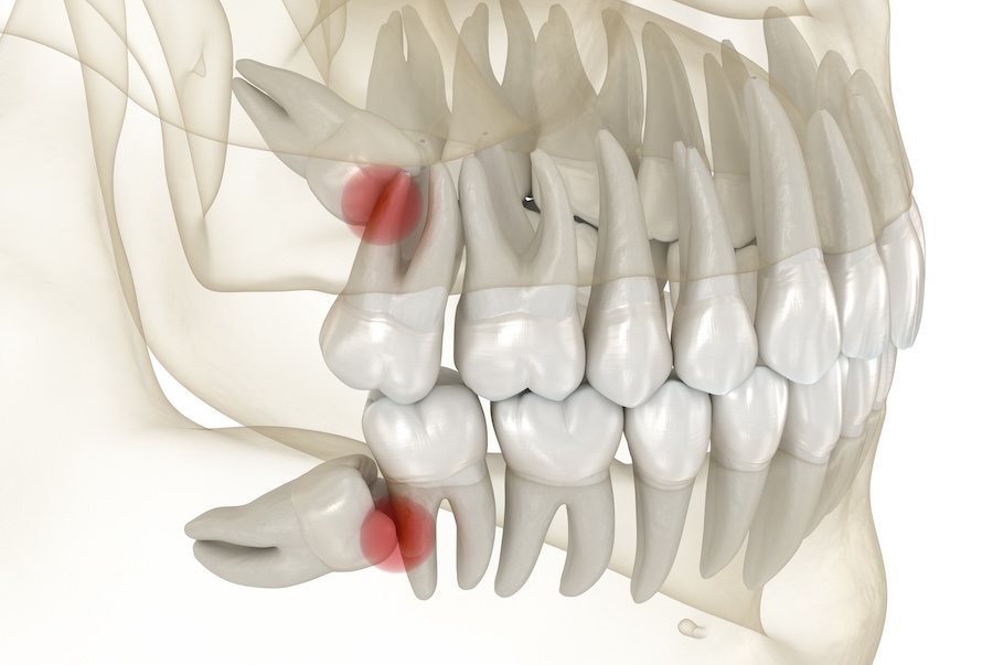 wisdom teeth removal, wisdom teeth pain and impaction