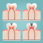 dental caries, cavities, dental filling