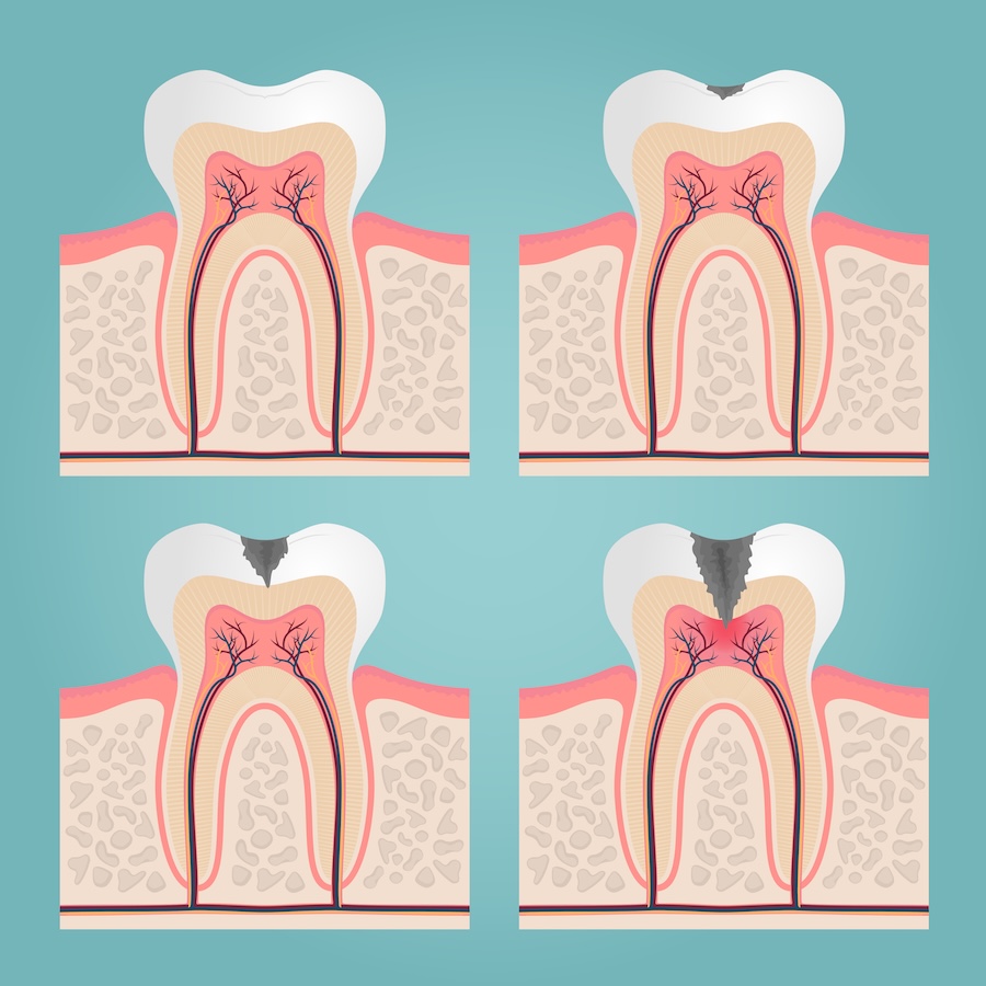 dental caries, cavities, dental filling